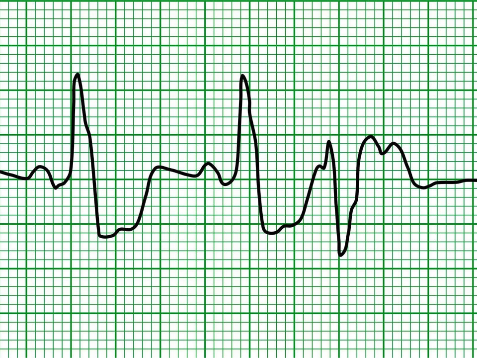 EKG-Aufzeichnung einer ventrikulären Extrasystole