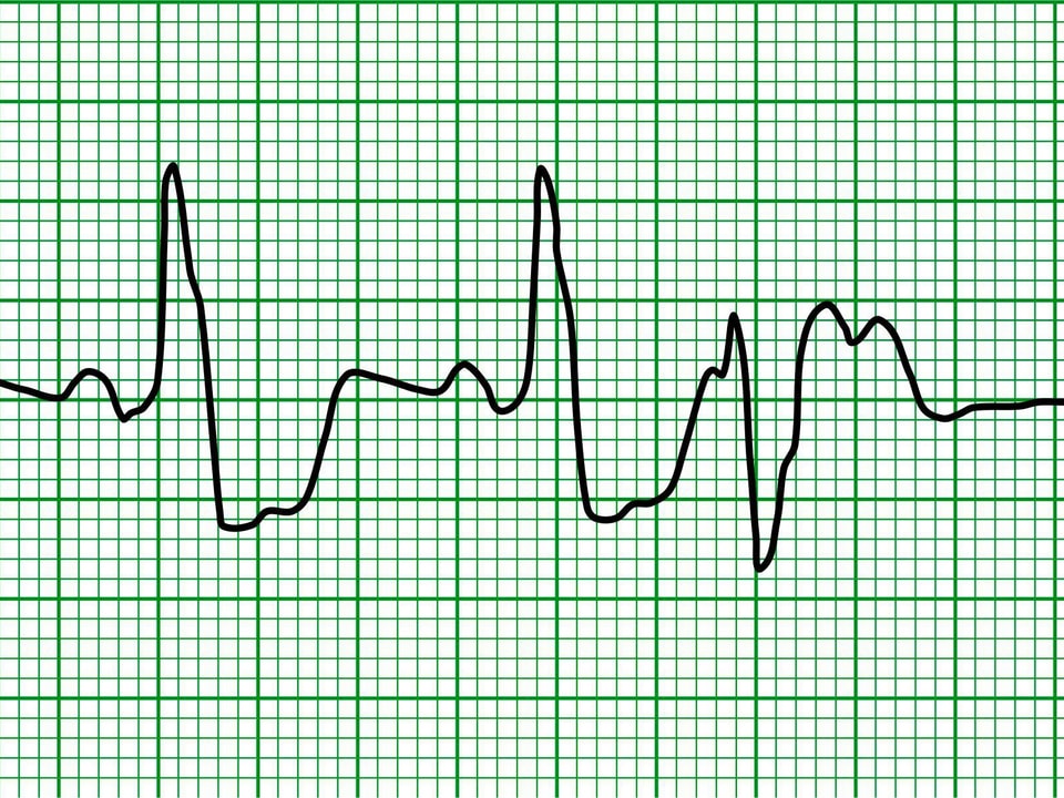 EKG-Aufzeichnung einer ventrikulären Extrasystole
