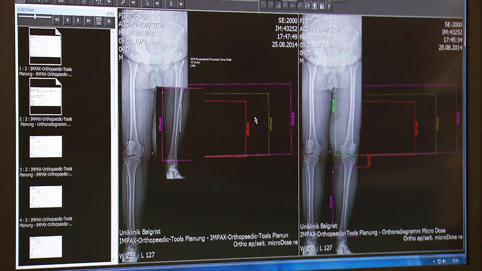 Vergleichende Röntgenaufnahme vor und nach deer Beinamputation.