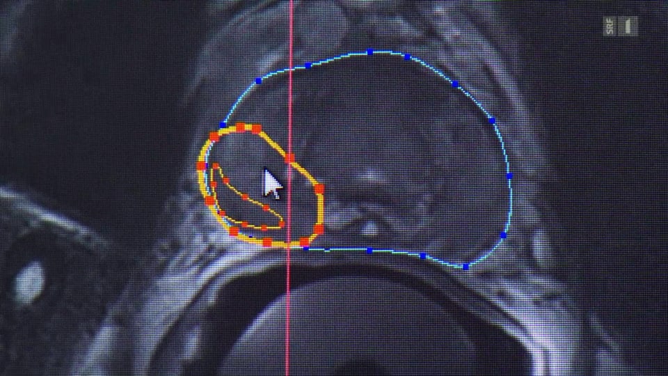 Mit HIFU gegen den Tumor