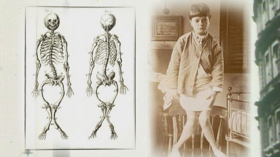 Rachitis Kind mit extremen X-Beinen, daneben eine Zeichnung des verformten Skeletts