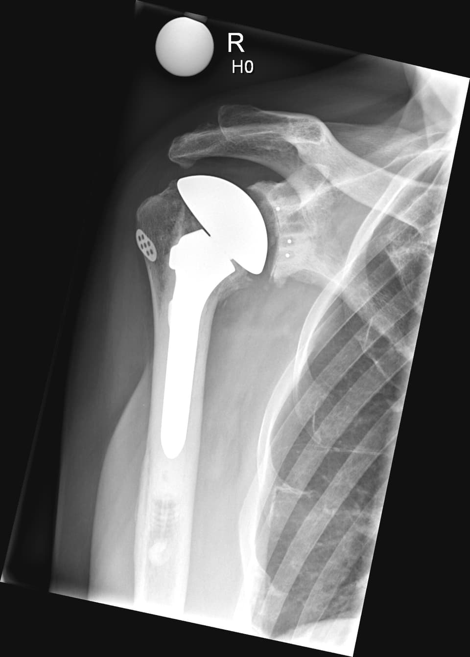 Anatomische Schulterprothese im Röntgenbild.