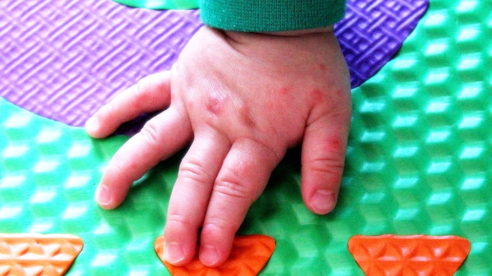 Ostschweiz HandMundFussKrankheit Ansteckend aber harmlos News SRF