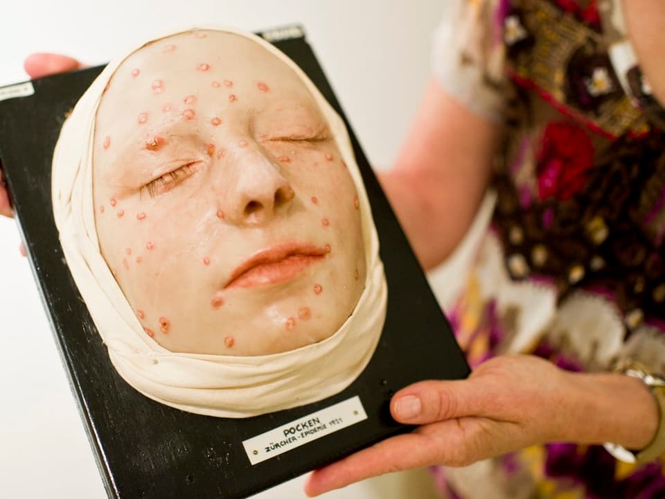 Ein medizinisches Modell eines Gesichtes mit dem typischen Hautausschlag durch Pockenviren. Gezeigt wurde das Ausstellungsstück in St. Gallen.