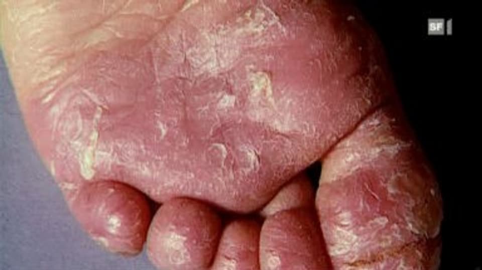 Alltag & Umwelt - Fusspilz aus dem Wäschekorb - Puls - SRF