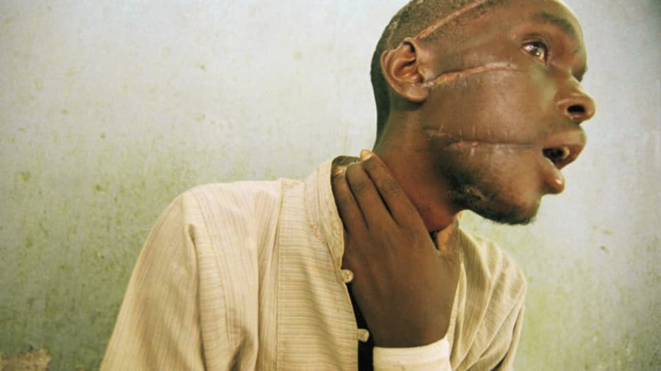 Opfer eines Machetenangriffs zeigt seine Wunden (1994).
