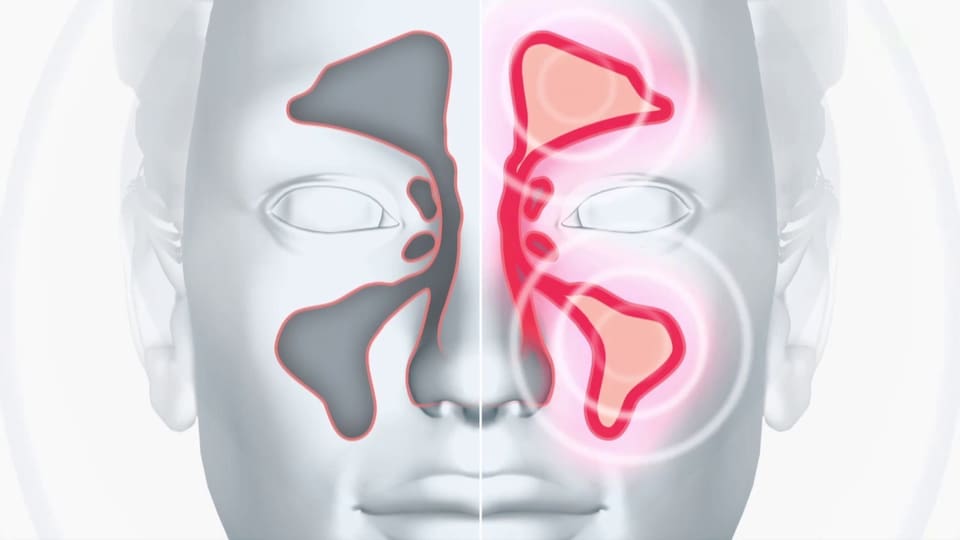 Körper & Geist Chronisch entzündete Nasenschleimhaut Ein häufiges Leiden Puls SRF