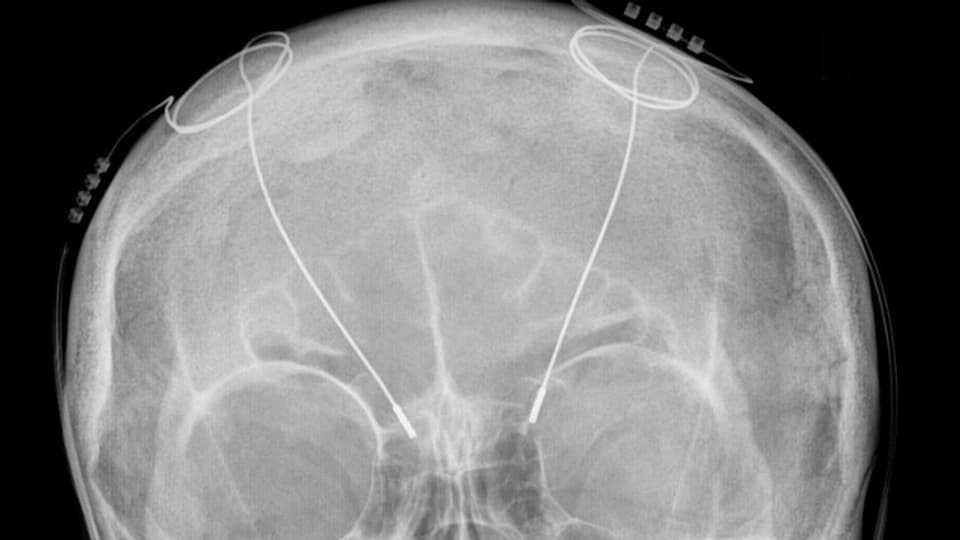 Röntgenaufnahme der Sonden eines Hirnschrittmachers