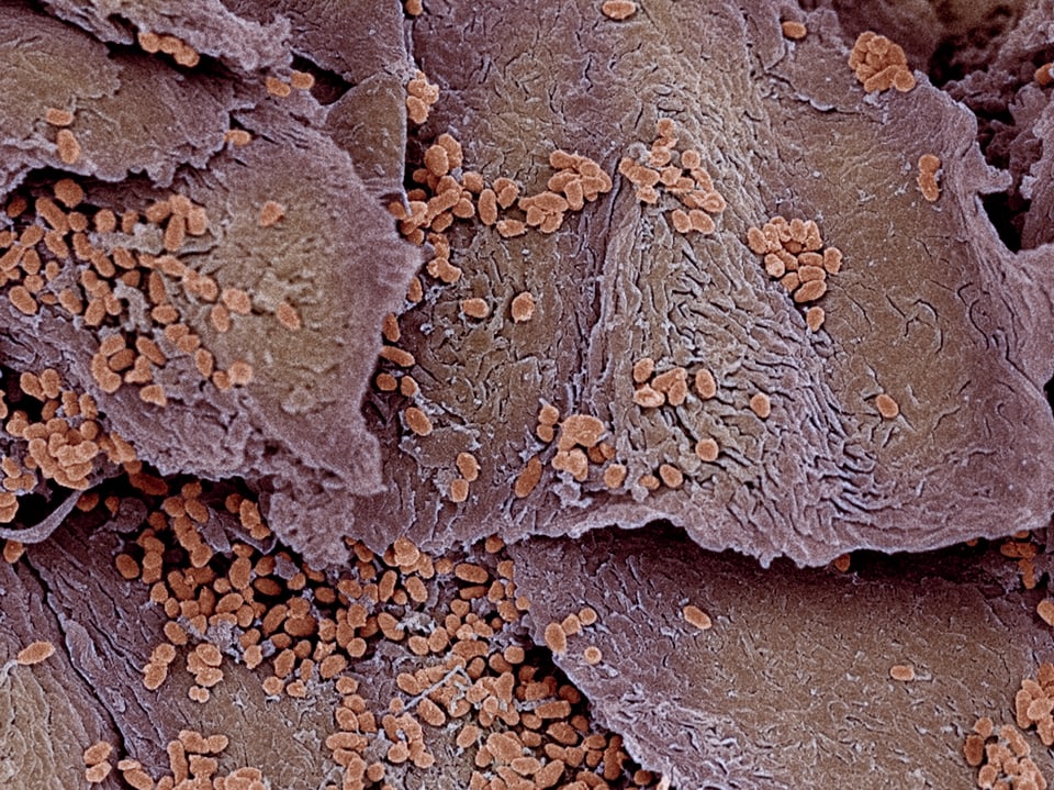 Nagelplatte mit Bakterienbefall