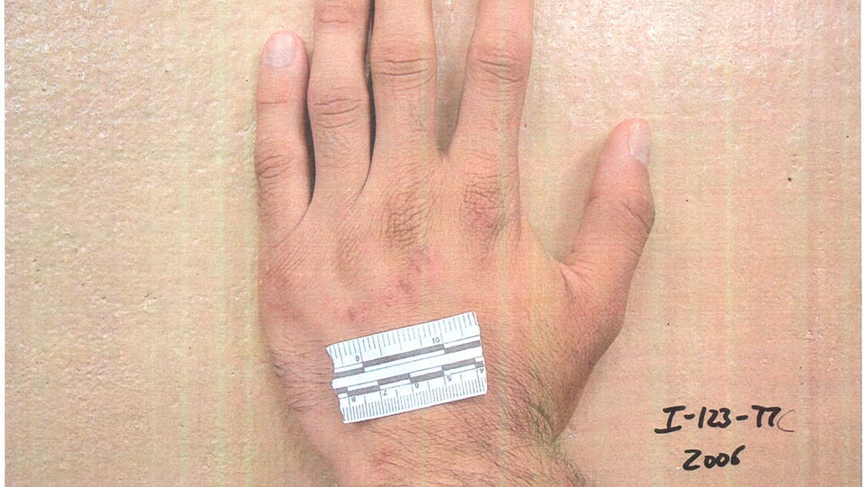 Hand mit kleiner Wunde und Zentimetermassstab