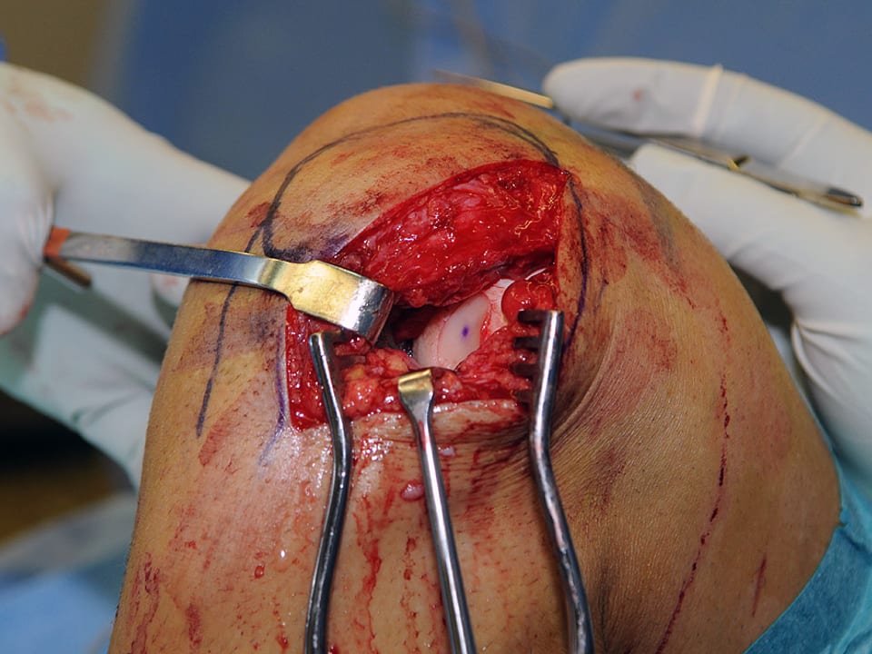 Aufgeschnittenes Knie, das von Operationsbesteck offen gehalten wird. Darin das eingesetzte Knorpelstück.