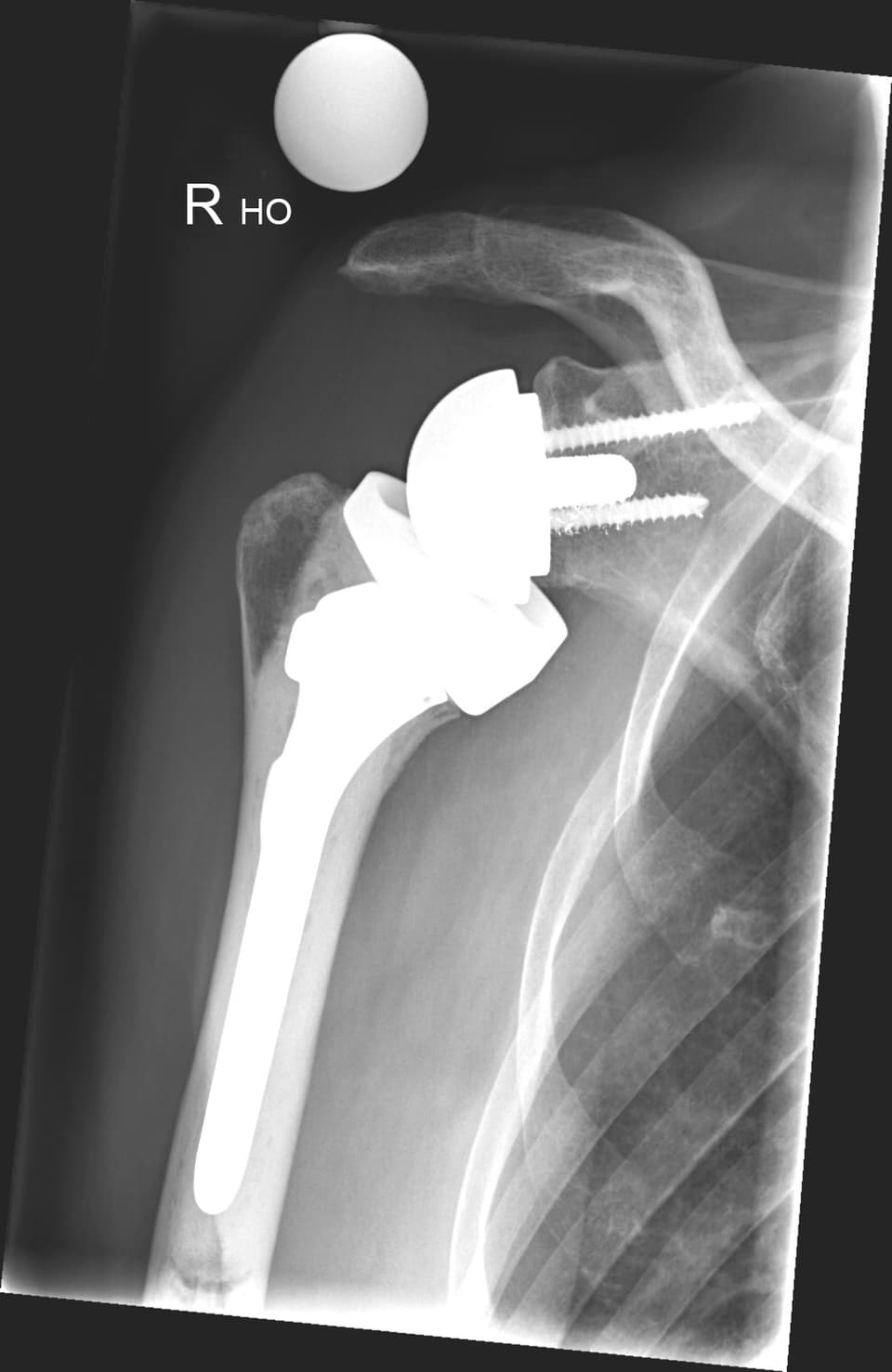 Röntgenbild der Schulter mit der eingesetzten Prothese. 