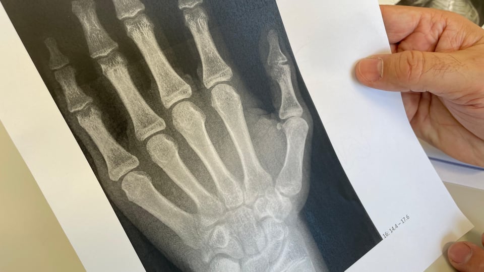Röntgenbild von Handknochen 