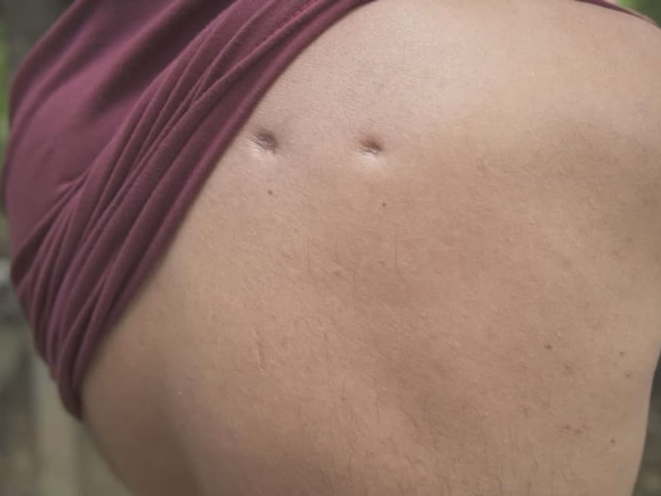 Ein Bild eines entblössten Rückens, worauf Narben von Schusswunden zu sehen sind.
