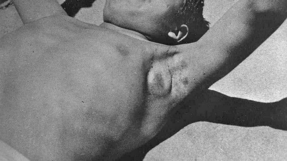 Schwarzweiss-Foto eines Patienten mit einer Pestbeuel in der Achselhöhle