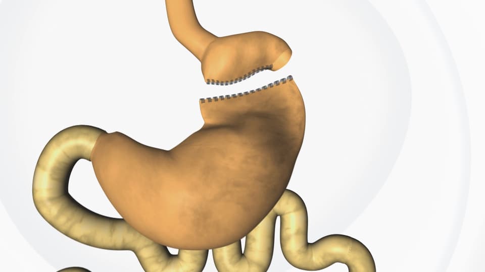 Modell eines von der Speiseröhre abgetrennten Magens