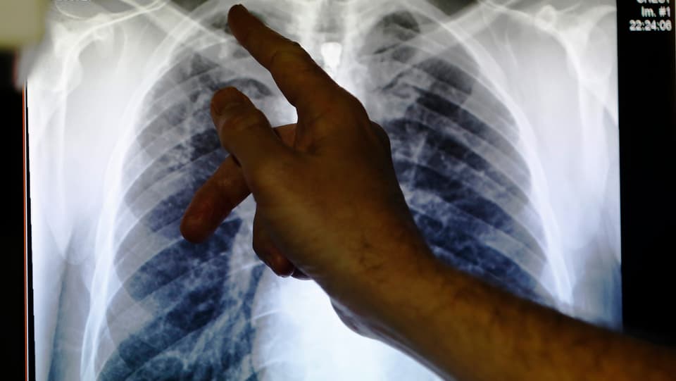 Jemand zeigt mit dem Zeigefinder auf ein Röntgenbild einer Lunge.