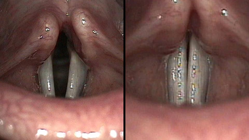 Markoaufnahmen von Stimmlippen im menschlichen Hals