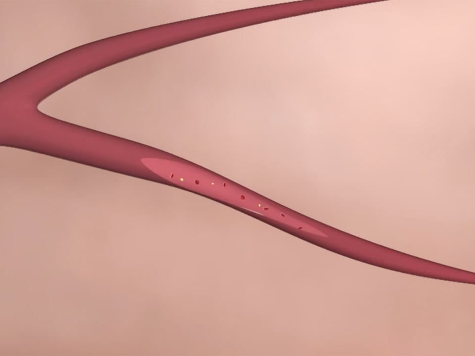 Grafische Nahaufnahme einer Herzkranzarterie, teilweise mit Blick in das Innere