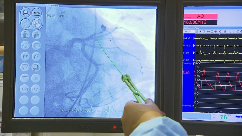 Bildschirmdarstellung einer verengten Vene, entdeckt mit einem Herzkatheter