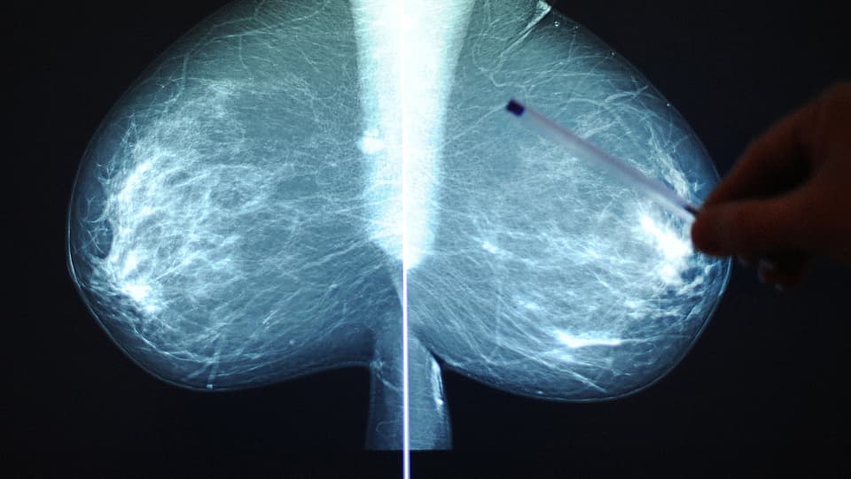 Jemand zeigt mit einem Kugelschreiber auf ein Röntgenbild mit zwei Brüsten.