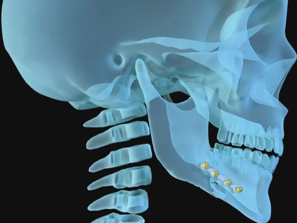Visualisierung eines Implantats am gebrochenen Kieferknochen.