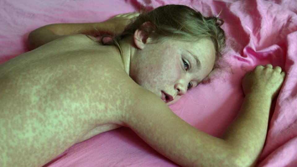 Ein siebenjähriges Mädchen aus dem Kanton Schwyz, das 2003 an Masern erkrankt ist.