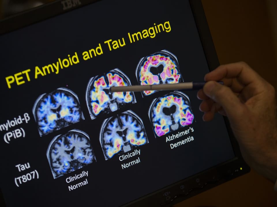 Mão aponta para tomografias PET do cérebro para análise da doença de Alzheimer.