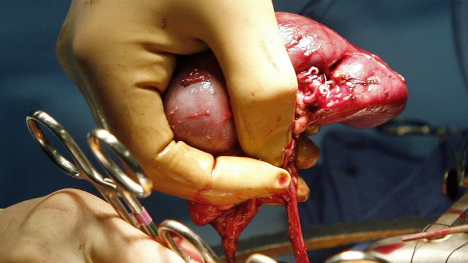 Eine Niere wird für eine Transplantation entfernt.