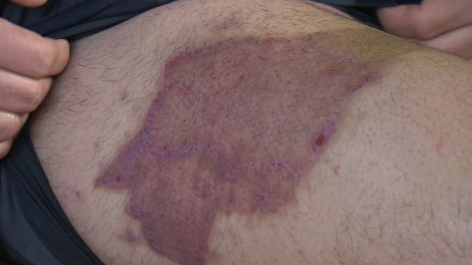 Verletzte Haut am Bein.