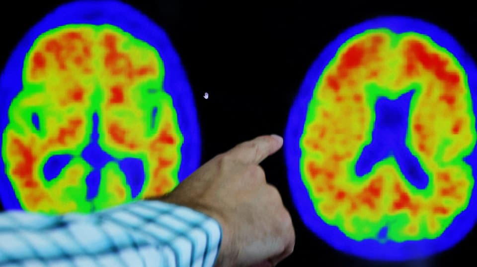 Hand deutet auf Röntgenaufnahmen des Gehirns