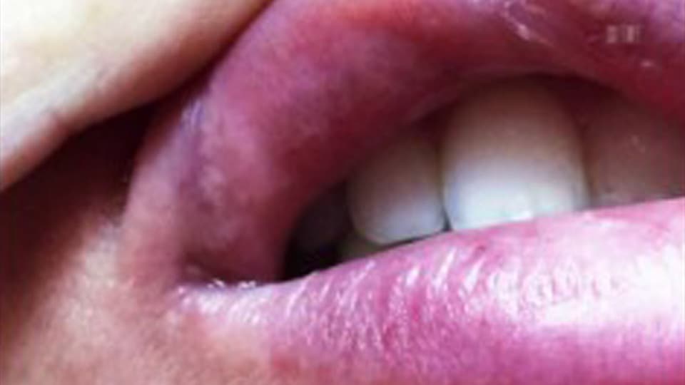 Irreversible Schäden: Knötchen innen an der Lippe. Innen an der Lippe: Kreis mit Kötchen