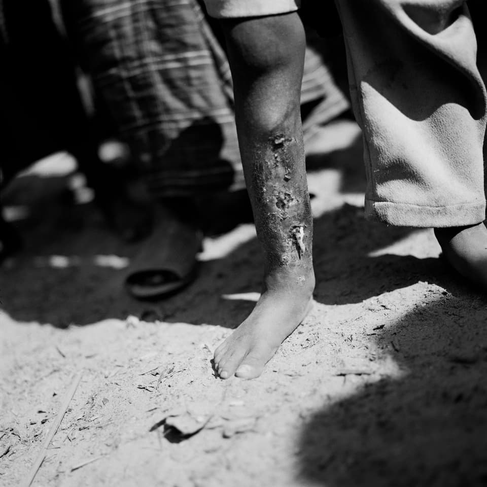 Black and white photo of a child's shin with several open wounds, with another person standing in the background