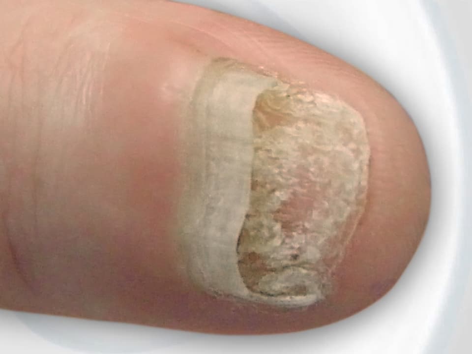 An Nagelpilz erkrankter Fingernagel.