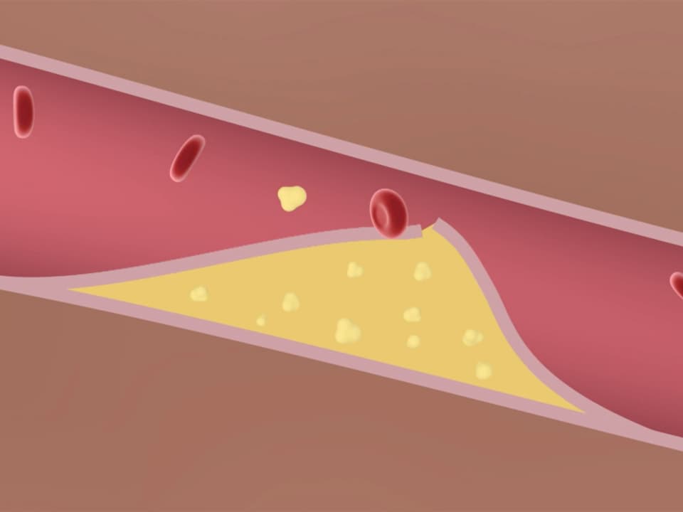 Grafischer Blick ins Innere eines Blutgefässes mit aufgerissenen Ablagerungen