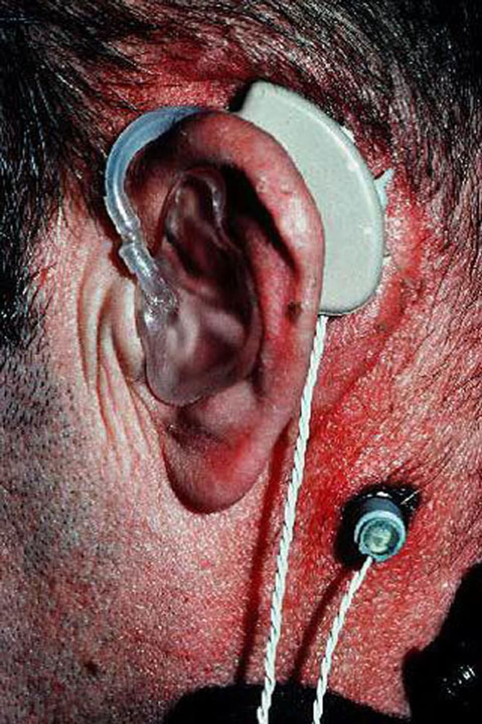 Geschichtliches Foto aus 1977 vom ersten Schweizer Patienten mit Cochlea-Implantat