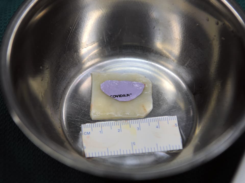 Das knapp 4 cm grosse Knorpelgewebe liegt in einer Metallschüssel, darauf die Vorlage, daneben ein Stück Massband.