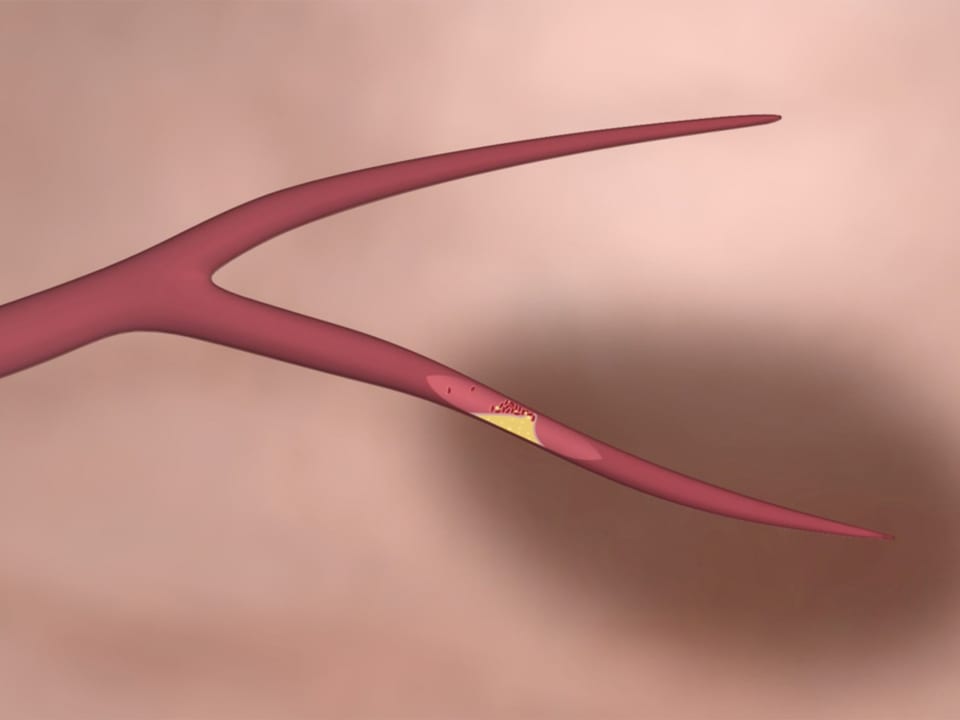 Grafische Darstellung einer verstopfte Blutbahn, dahinter dunkel eingefärbtes Gewebe