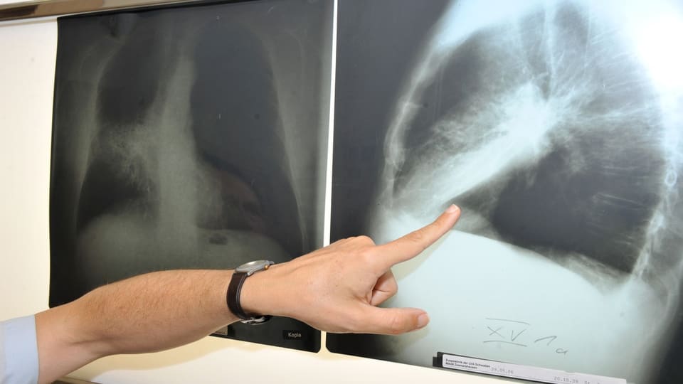 Eine Hand zeigt auf ein Röntgenbild. 
