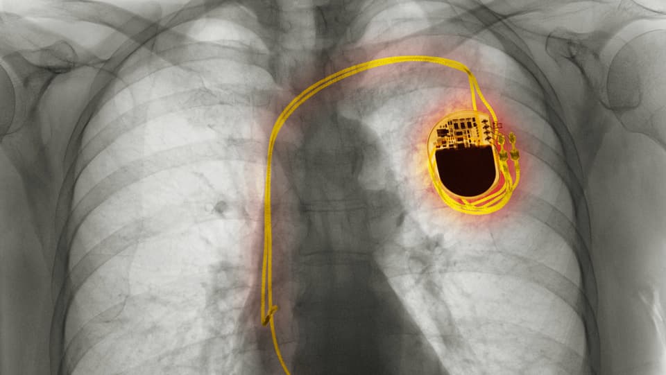 Torso-Röntgenaufnahme mit Herzschrittmacher.