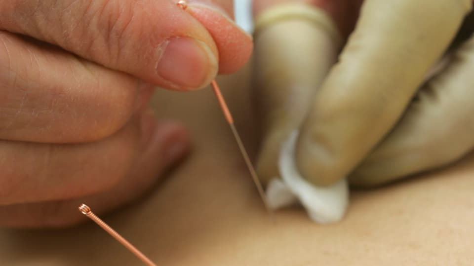 Eine Therapeutin setzt Akkupunkturnadeln auf den Rücken eines Patienten