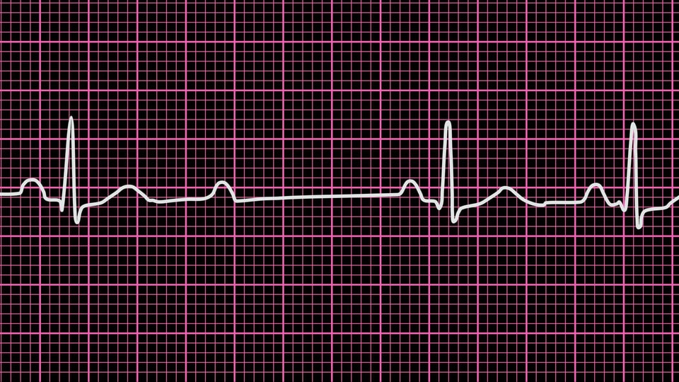 EKG-Aufzeichnung eines AV-Blocks 2. Grades