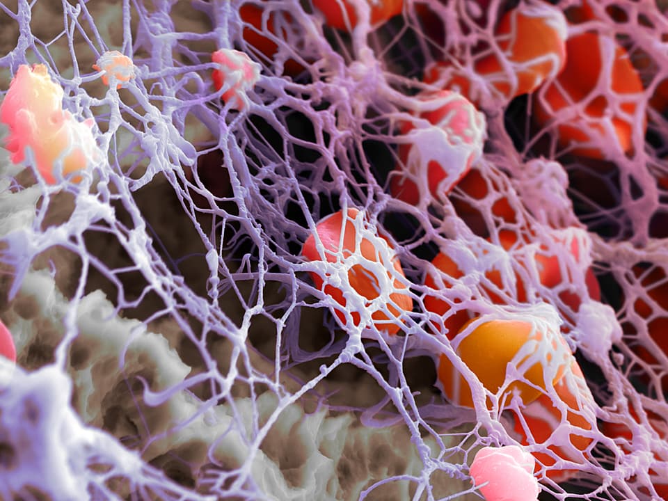 Rote Blutkörperchen sind gefangen in einem weissen Netz.
