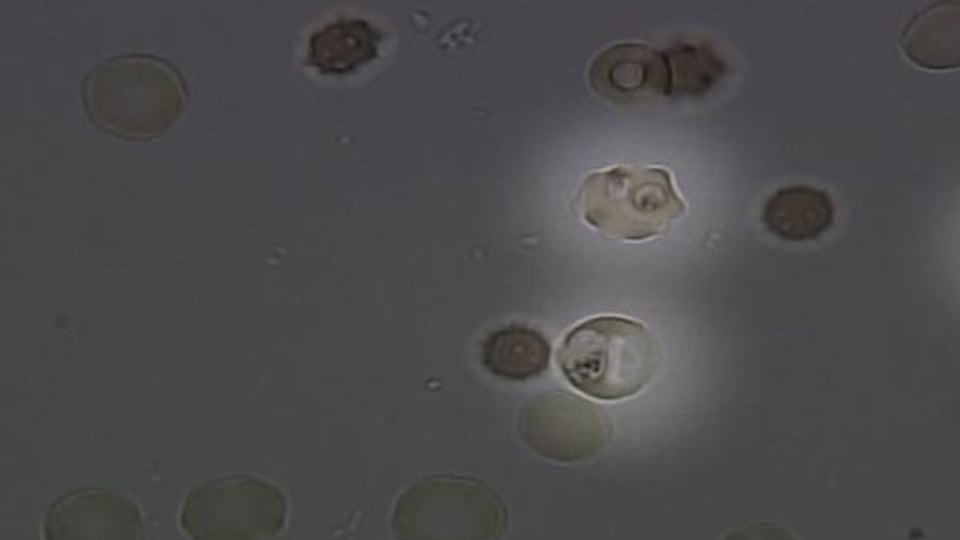 Malaria-Erreger unter dem Mikroskop