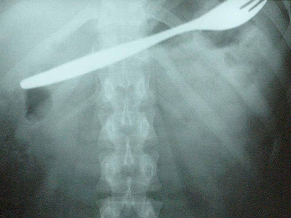 Röntgenbild mit Gabel im Magen.