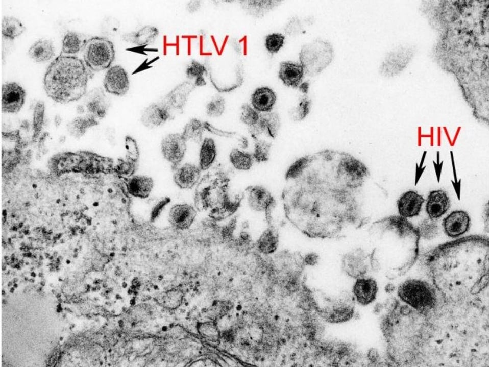 Das Bild zeigt die Präsenz von HTLV1 und HIV in einem menschlichen Organismus. 