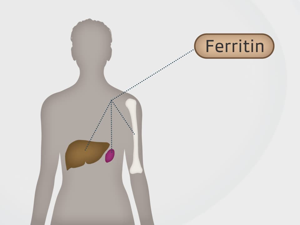 Infusionen mit Eisen Wie viel Eisen darf es sein? News SRF