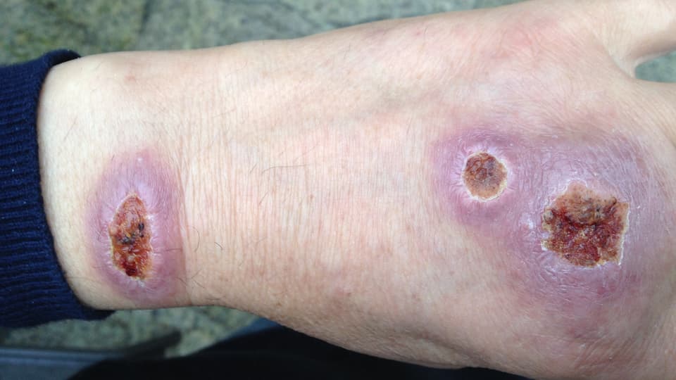 Tangan yang terinfeksi leishmaniasis setelah dua minggu.