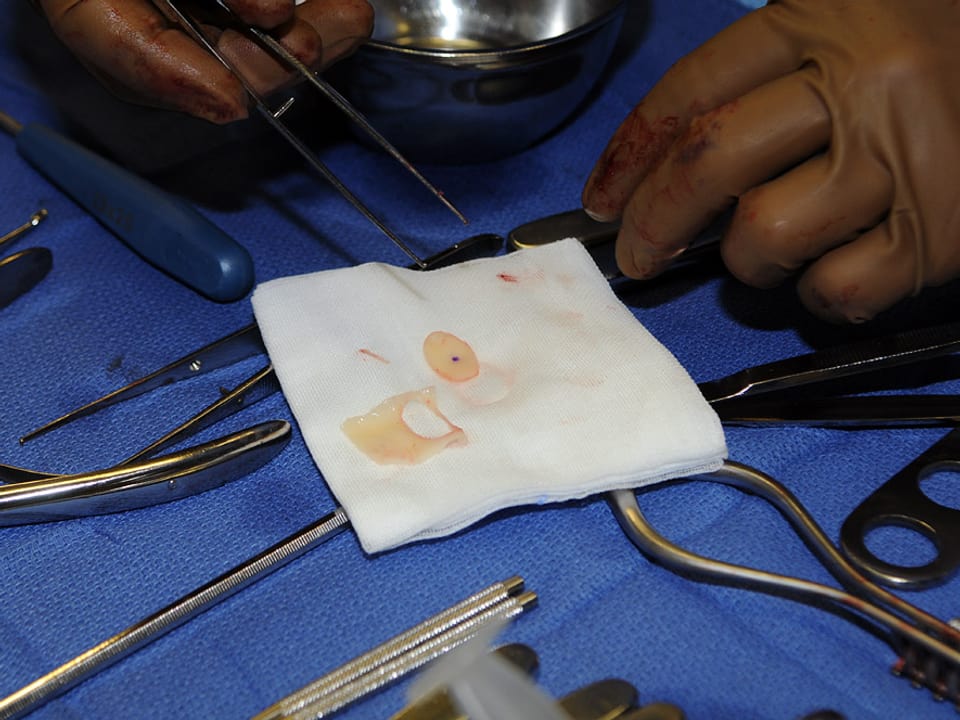 Das Knorpelgewebe liegt auf einem sterilen Gazetuch, umgeben von chirurgischen Geräten