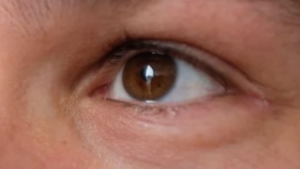 Durchbruch am Basler Augenspital: Gentherapie gegen Erblindung